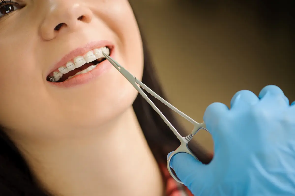 ceramic_braces