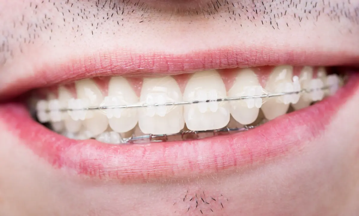 ceramic_braces