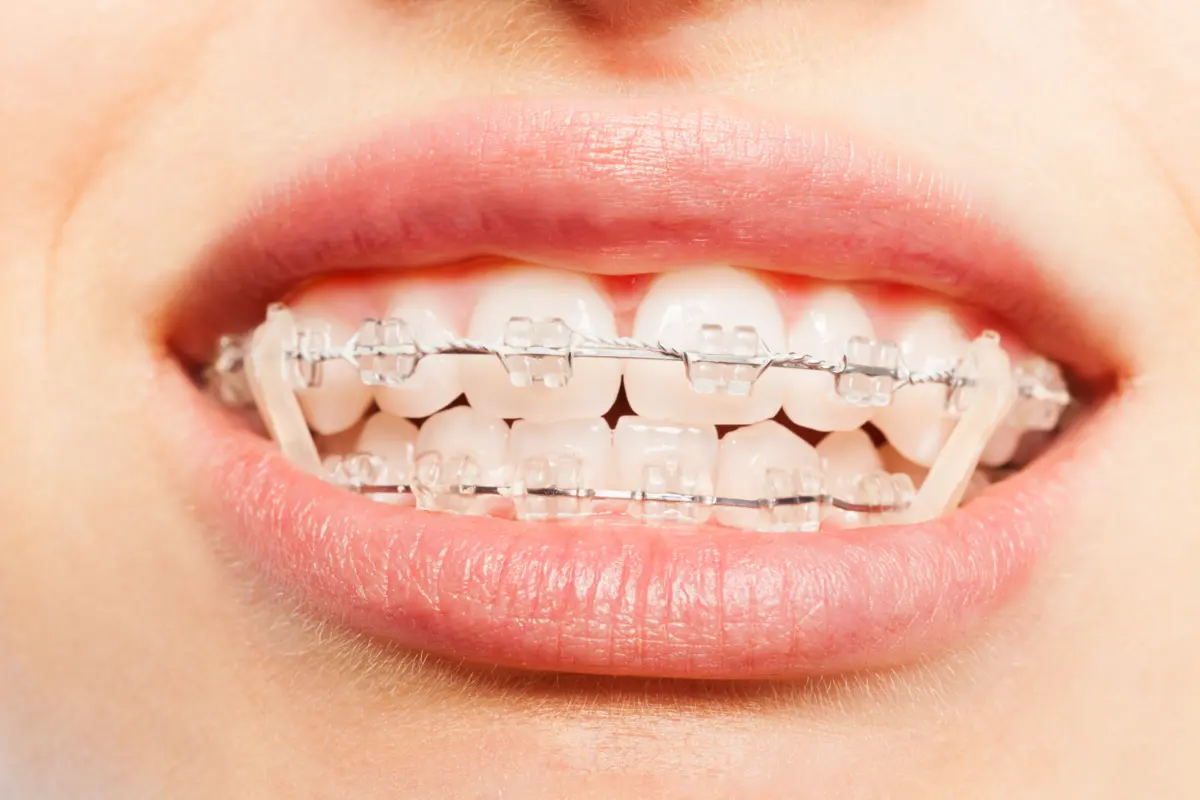 ceramic_braces