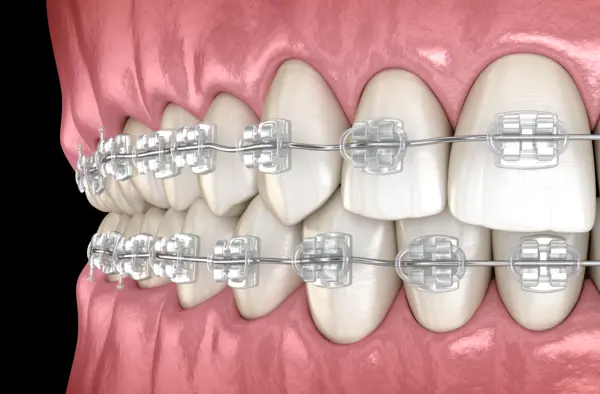 ceramic_braces_3d