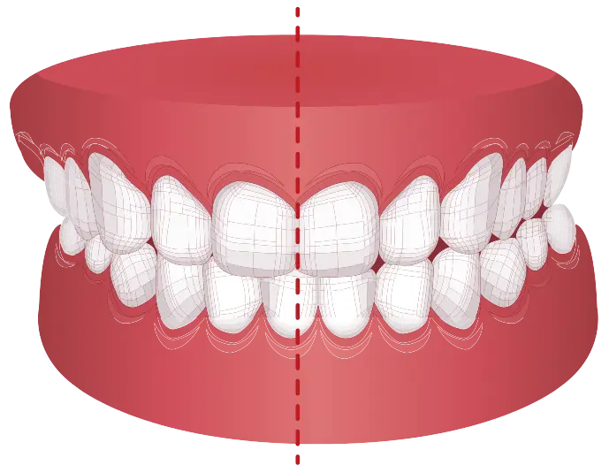 crossbite
