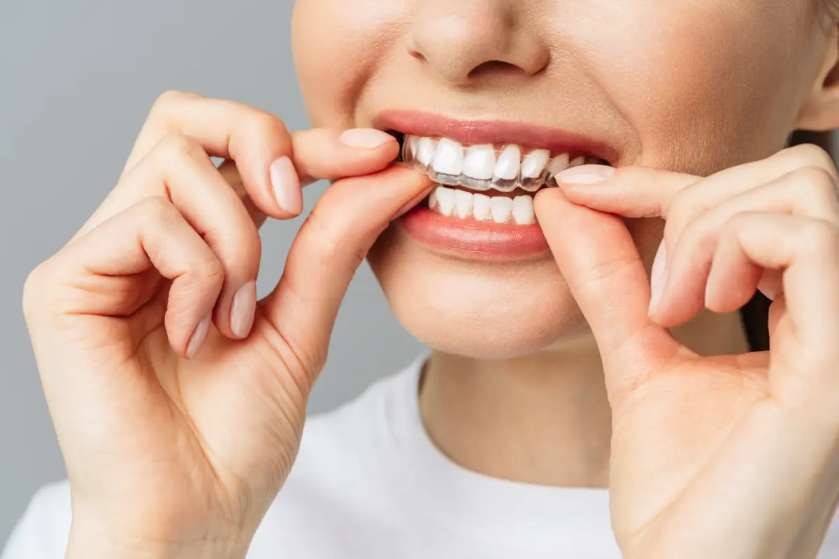 essix_retainer