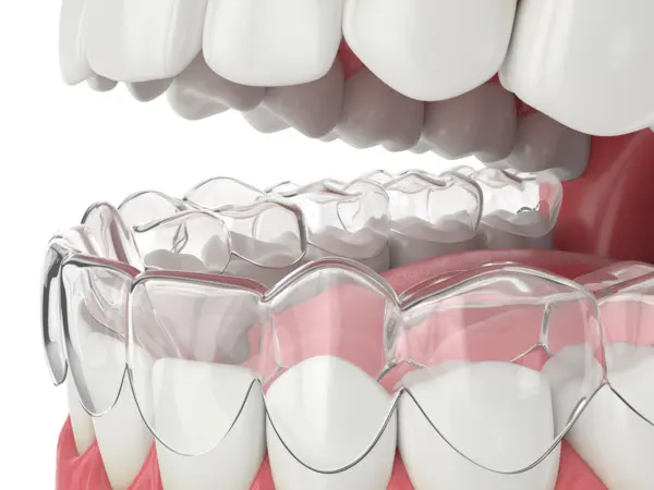 essix_retainer