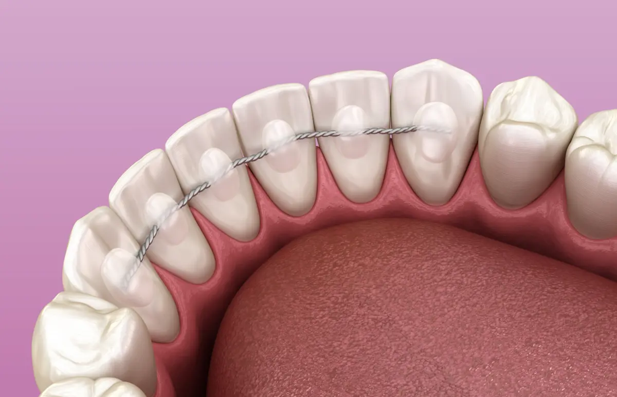 fixed_retainer