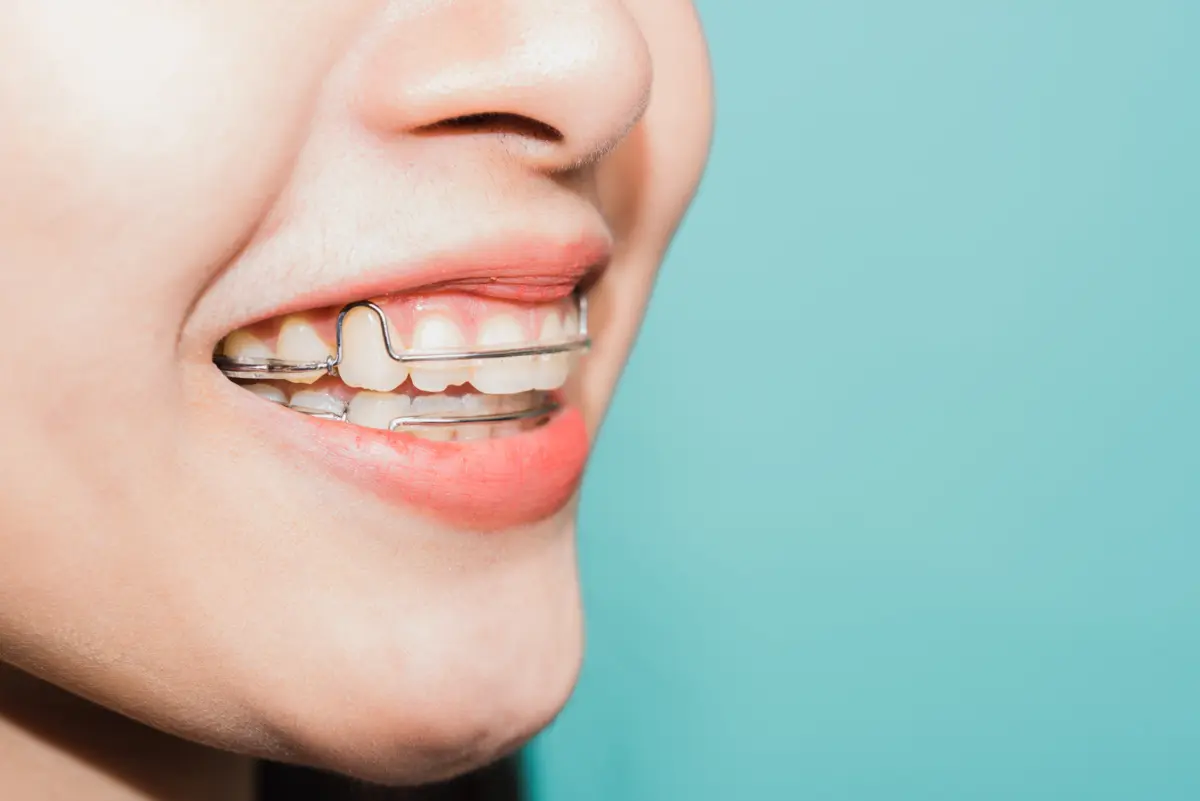 hawley_retainer