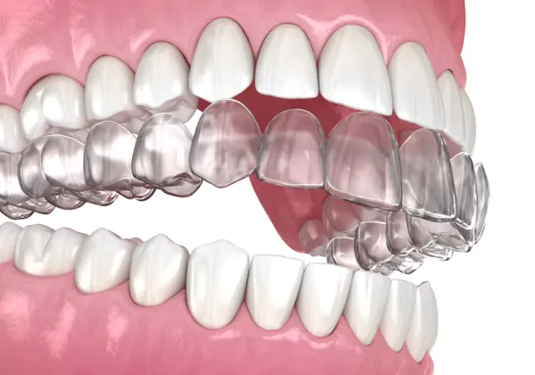 invisalign