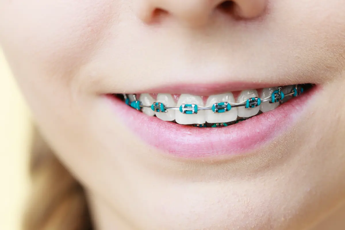 metal_braces_cleaning