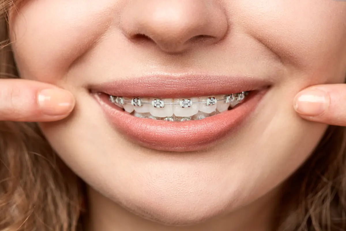 metal_braces