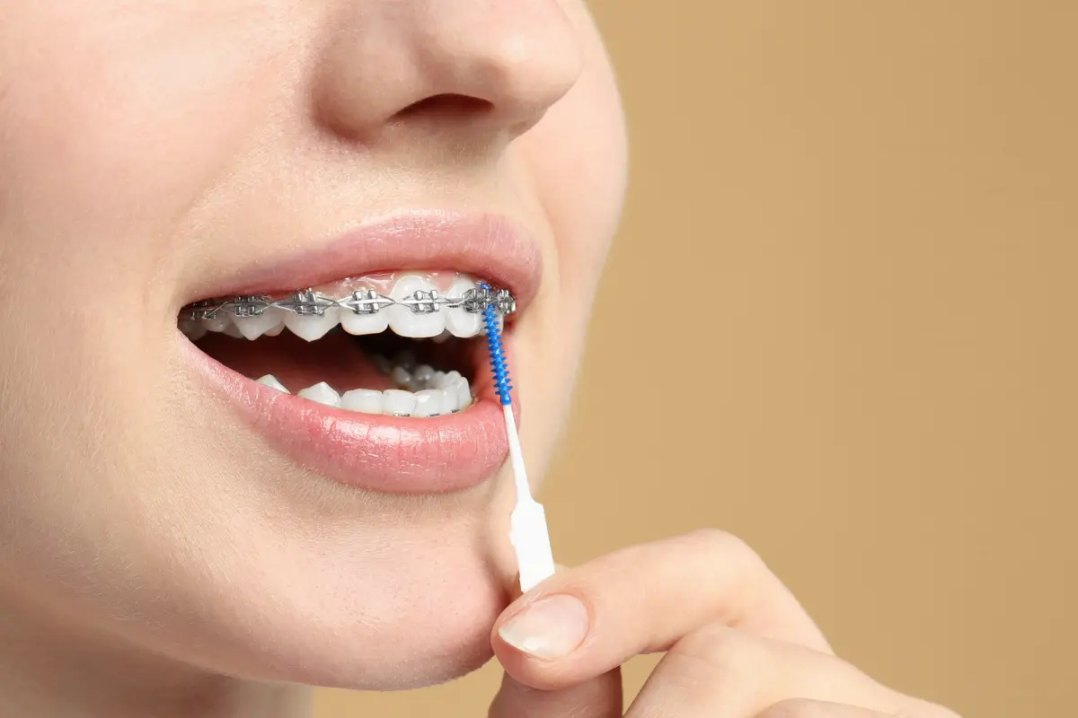 metal_braces_cleaning
