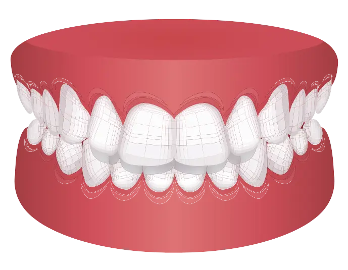 overbite